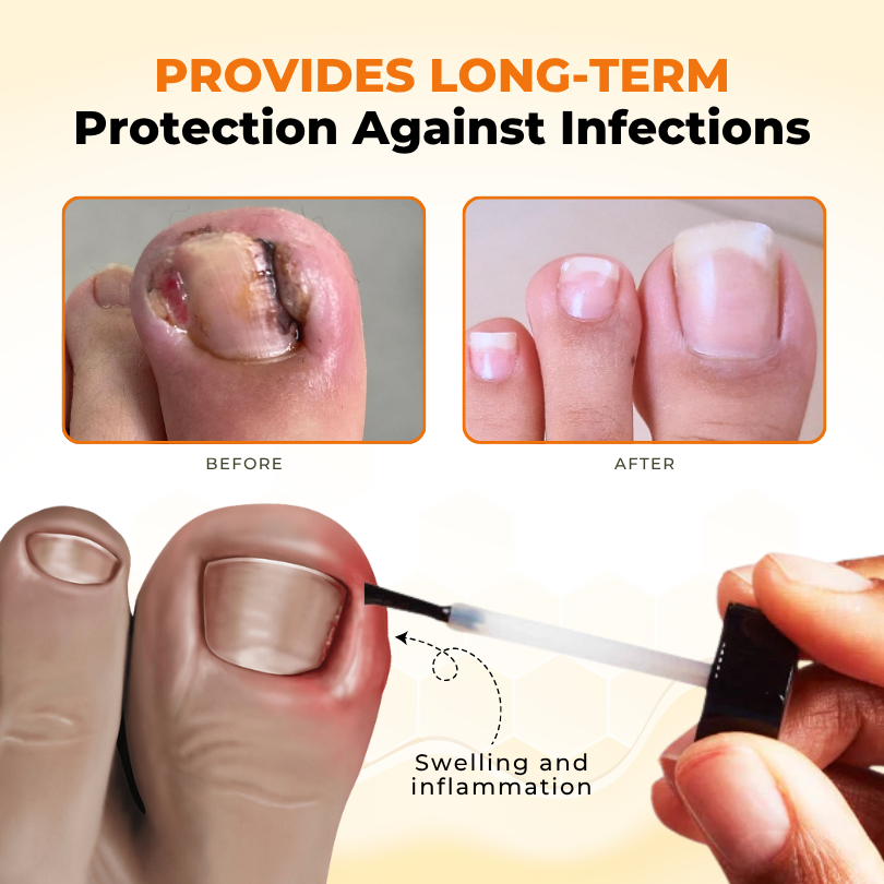 Timilk® NailRevive Bee Venom Anti-fungi Solution.