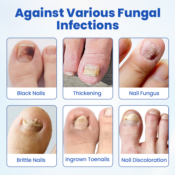 Timilk® FungalPatch - Antibacterial Fungal Patch.