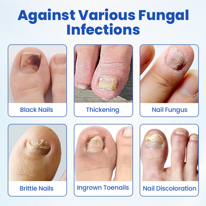 Timilk® FungalPatch - Antibacterial Fungal Patch.
