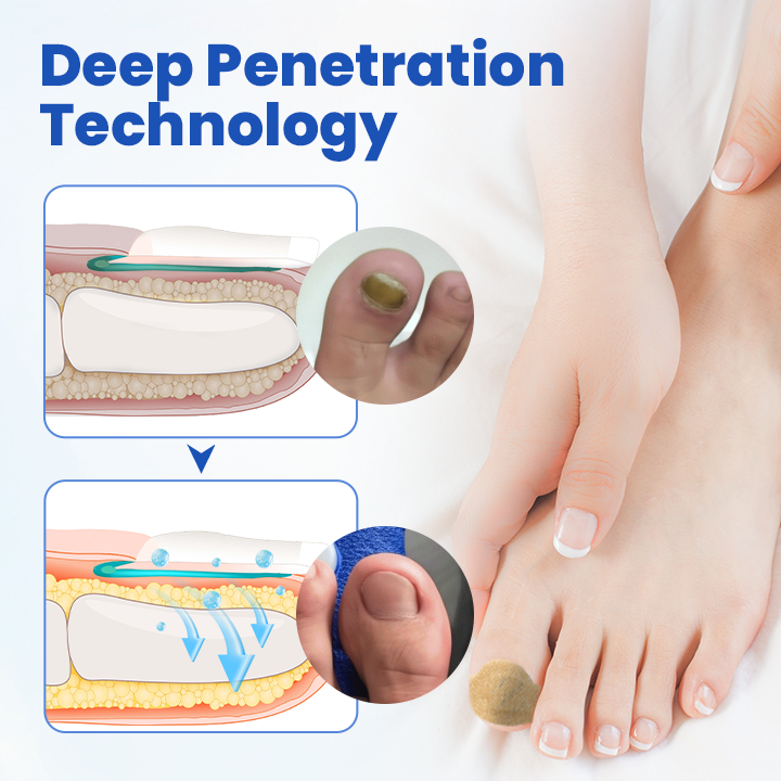 Timilk® FungalPatch - Antibacterial Fungal Patch.