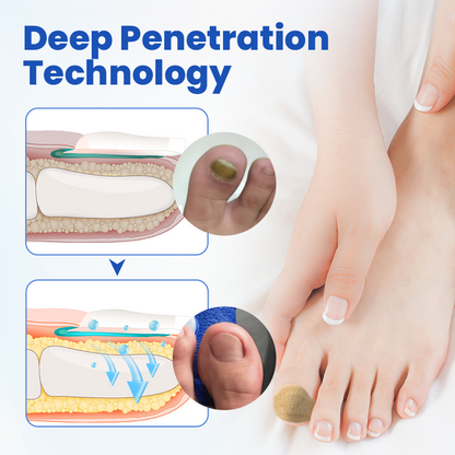 Timilk® FungalPatch - Antibacterial Fungal Patch.