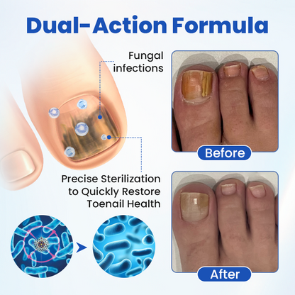 Timilk® FungalPatch - Antibacterial Fungal Patch.