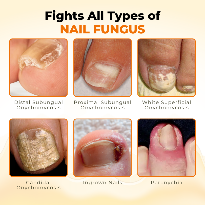 Timilk® NailRevive Bee Venom Anti-fungi Solution.