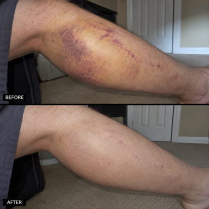 Timilk® BruiseFade Pro Skin Repair Cream